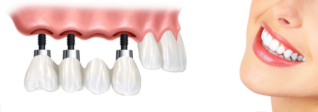 Trồng răng implant